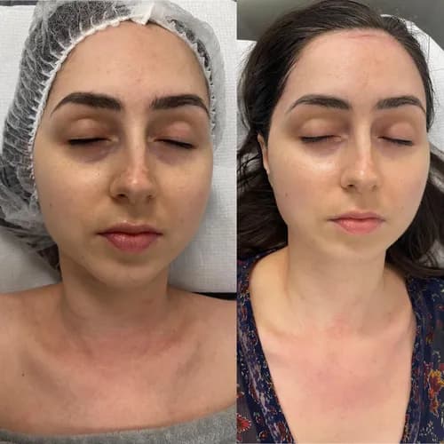 Delikatne usuwanie włosków pęsetą