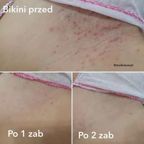 Лазерное удаление волос из интимной зоны по лучшим ценам