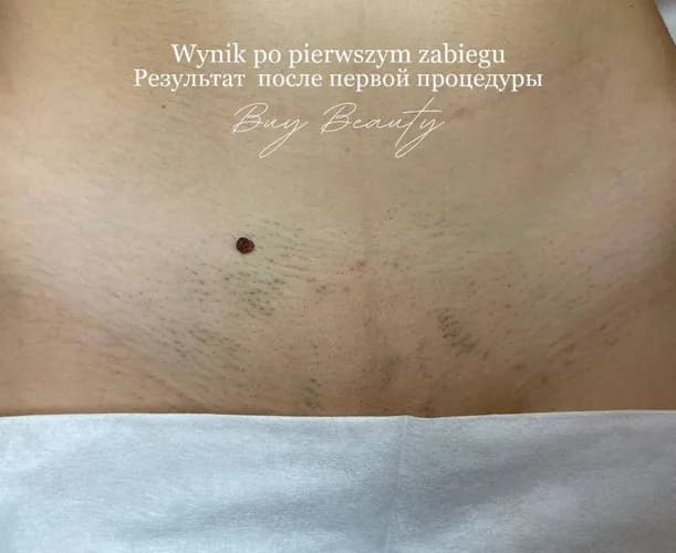 Лазерное удаление волос из интимной зоны