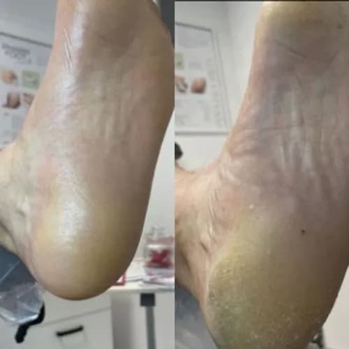 Pedicure oczyszczanie stóp