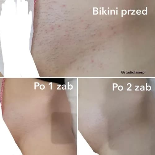 Laserowa depilacja bikini