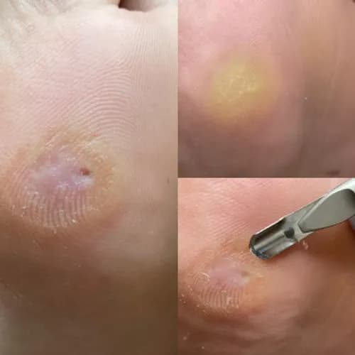 Здоровые стопы без мозолей