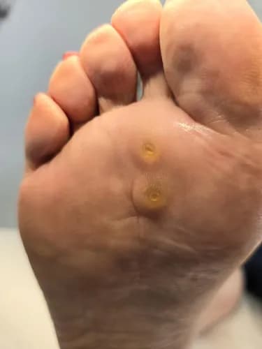 Легкое избавление от мозолей