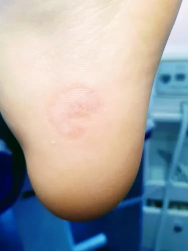 Usuwanie modzeli i regeneracja skóry stóp