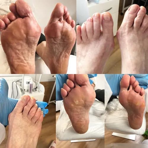 Leczenie i usuwanie modzeli