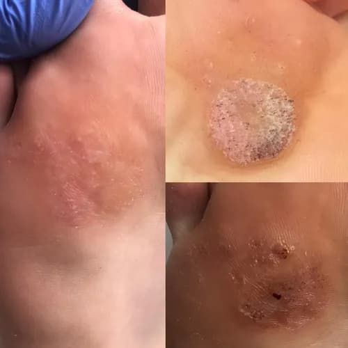 Leczenie i usuwanie modzeli