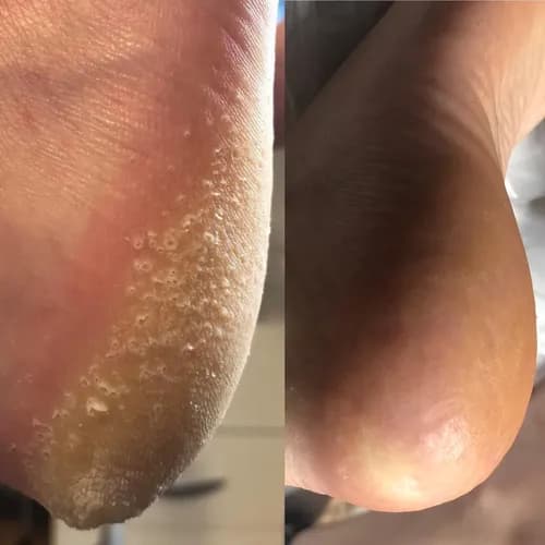 Leczenie i usuwanie modzeli