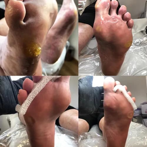 Leczenie i usuwanie modzeli