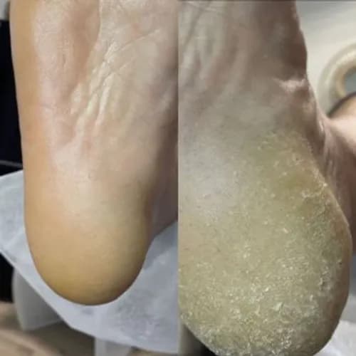 Leczenie popękanej skóry na stopach