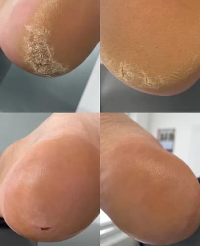 Комплексный уход за потрескавшимися пятками