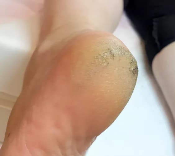 Интенсивная терапия для потрескавшихся стоп