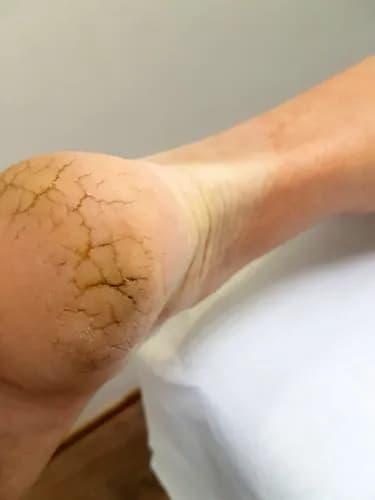 Интенсивная терапия для потрескавшихся стоп