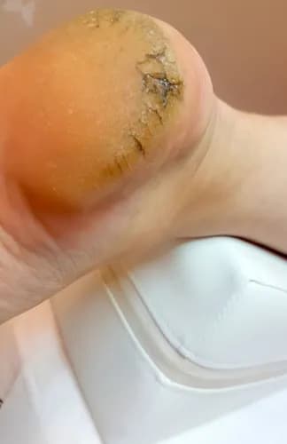 Интенсивная терапия для потрескавшихся стоп