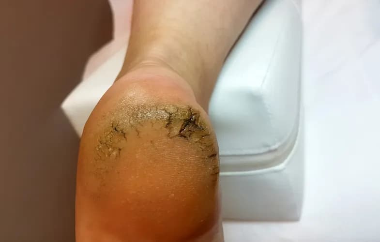 Интенсивная терапия для потрескавшихся стоп