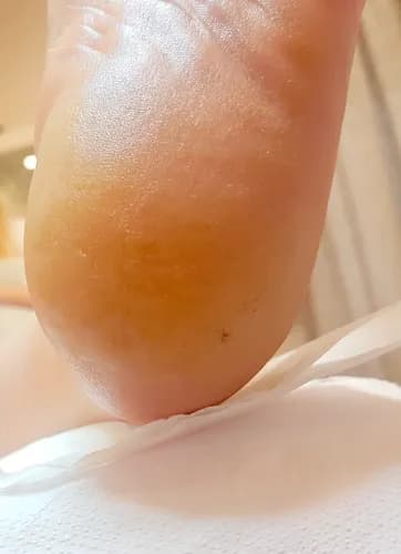 Интенсивная терапия для потрескавшихся стоп