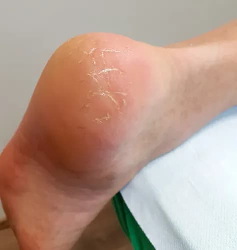 Интенсивная терапия для потрескавшихся стоп