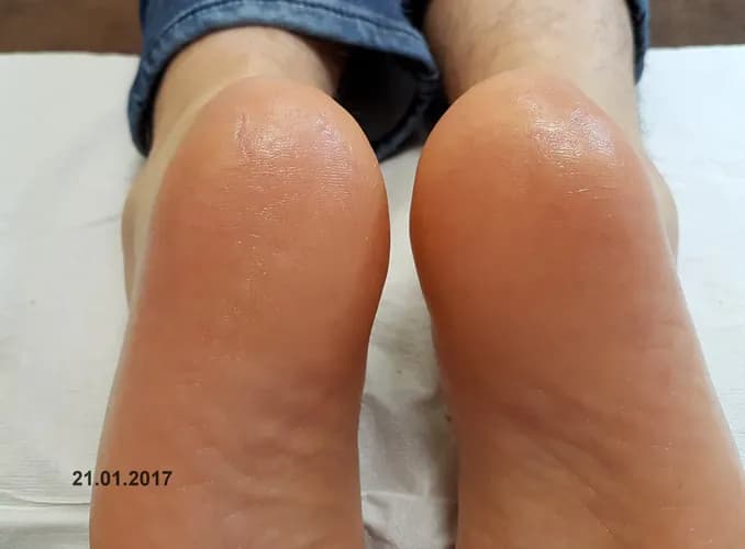 Интенсивная терапия для потрескавшихся стоп