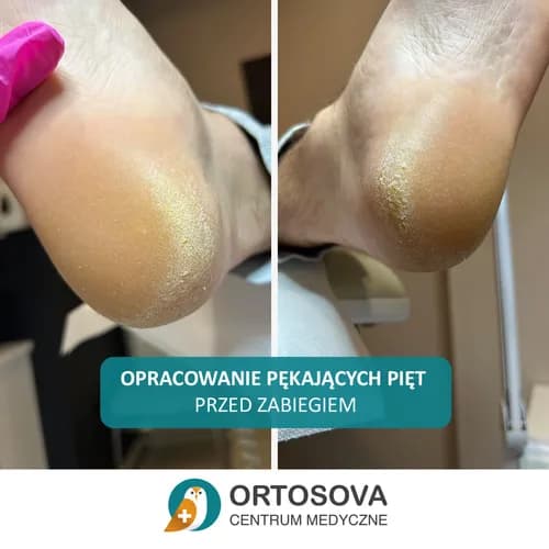 Специализированный уход за кожей пяток