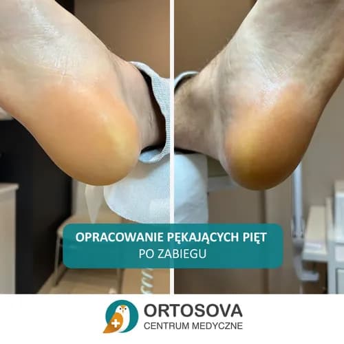 Специализированный уход за кожей пяток