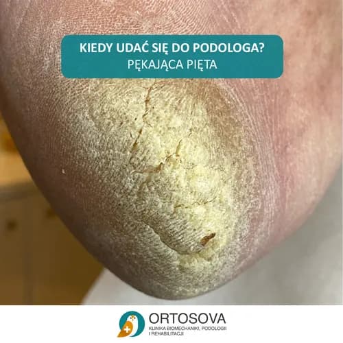 Специализированный уход за кожей пяток