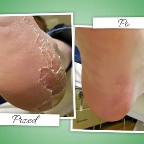 Leczniczy pedicure dla pięt