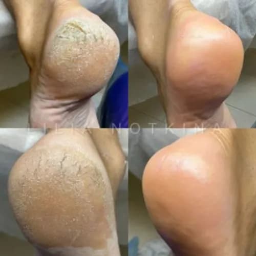 Реанимация потрескавшейся кожи на пятках