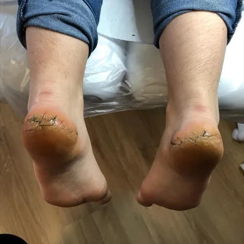 Реабилитация сухих и потрескавшихся пяток в нашем центре