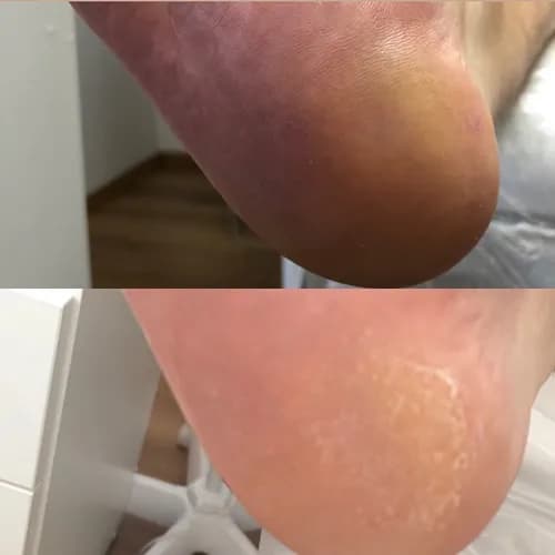 Rehabilitacja suchych i popękanych pięt w naszym centrum