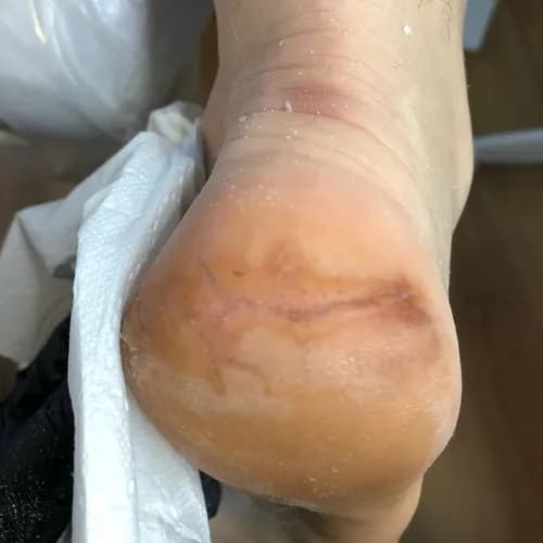 Реабилитация сухих и потрескавшихся пяток в нашем центре