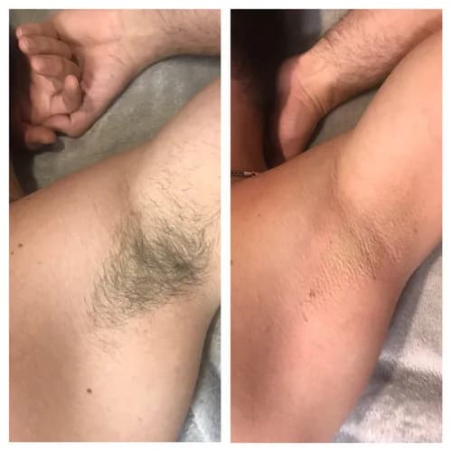 Profesjonalna pielęgnacja: depilacja cukrowa delikatnych okolic