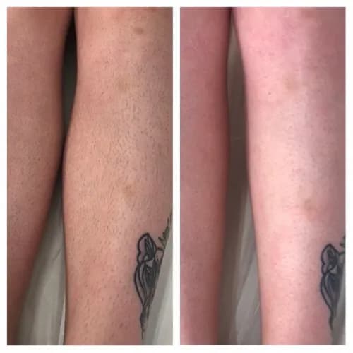 Skuteczna depilacja cukrowa nóg