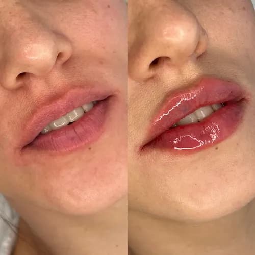 Zmysłowe usta po jednym zabiegu. Bezpieczne powiększanie