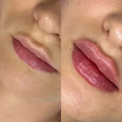 Profesjonalne powiększanie ust. Bezbolesny zabieg