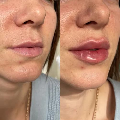 Tworzenie idealnego konturu ust. Doświadczony kosmetolog