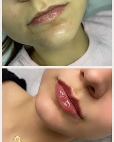 Uwodzicielskie usta bez efektu kaczki. Nowoczesne podejście