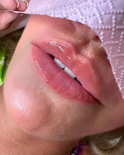 Powiększanie ust z zachowaniem naturalnych proporcji