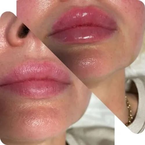 Powiększanie ust u certyfikowanego specjalisty