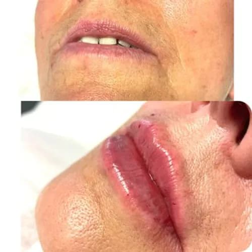 Powiększanie ust u certyfikowanego specjalisty