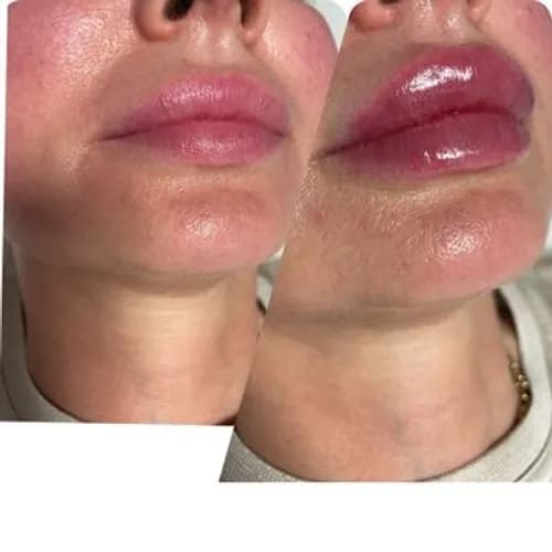 Powiększanie ust u certyfikowanego specjalisty