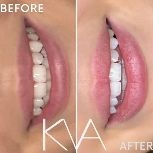 Idealne usta w jednej sesji. Sprawdzone preparaty