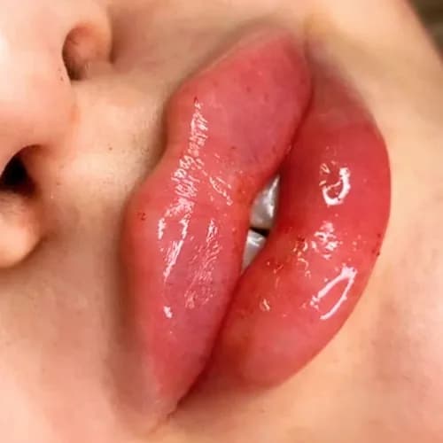 Контурная пластика губ. Стойкий эффект