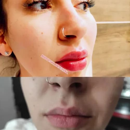 Контурная пластика губ. Стойкий эффект