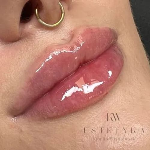 Metamorfoza ust bez rekonwalescencji. Natychmiastowy efekt