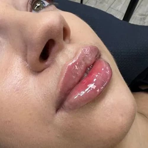 Metamorfoza ust bez rekonwalescencji. Natychmiastowy efekt