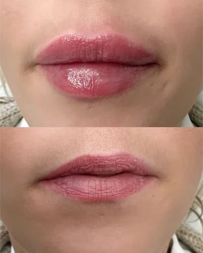 Powiększanie ust z gwarancją jakości. Bezpieczne materiały