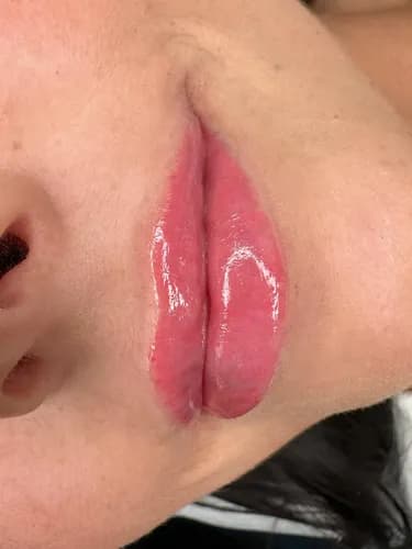 Powiększanie ust z gwarancją jakości. Bezpieczne materiały