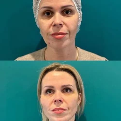 Korekta kształtu i objętości ust. Europejskie preparaty