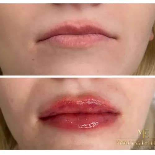 Zmysłowe usta bez operacji. Przystępne ceny