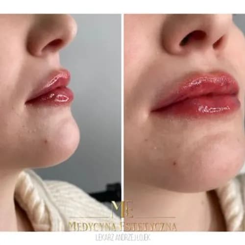 Zmysłowe usta bez operacji. Przystępne ceny