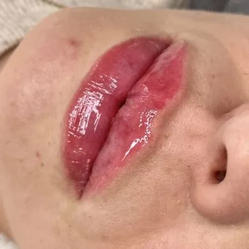 Powiększanie ust z uwzględnieniem anatomii. Harmonijny efekt